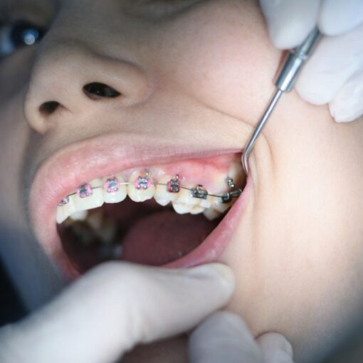 Zahnspange fürs Kind