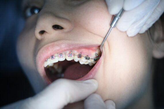 Zahnspange fürs Kind